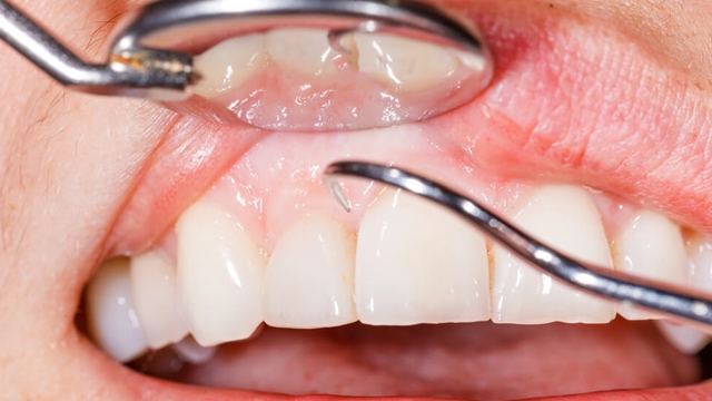 Diş Eti Hastalıkları Hakkında